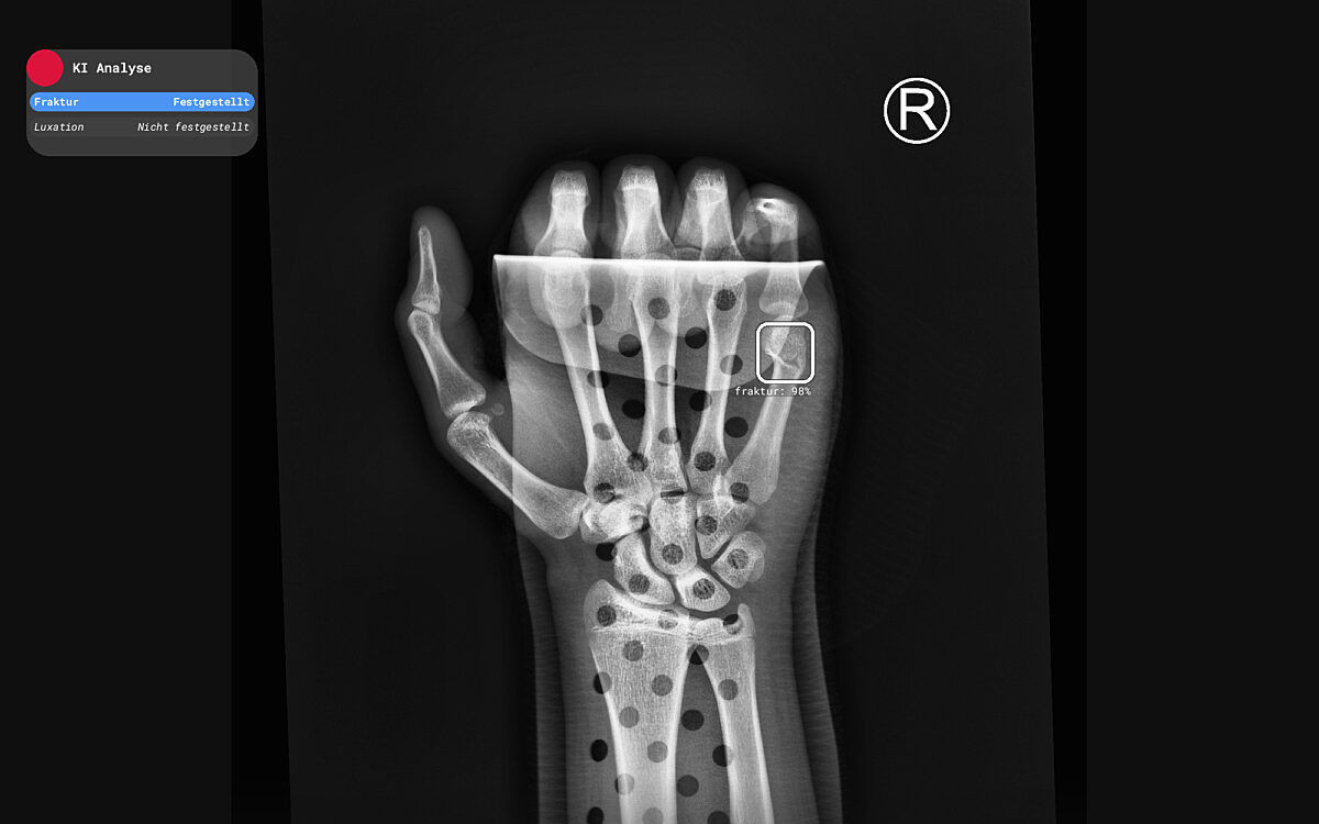 Hand Fraktur R Bfracture by Radiobotics Hand Fraktur R Bfracture by Radiobotics