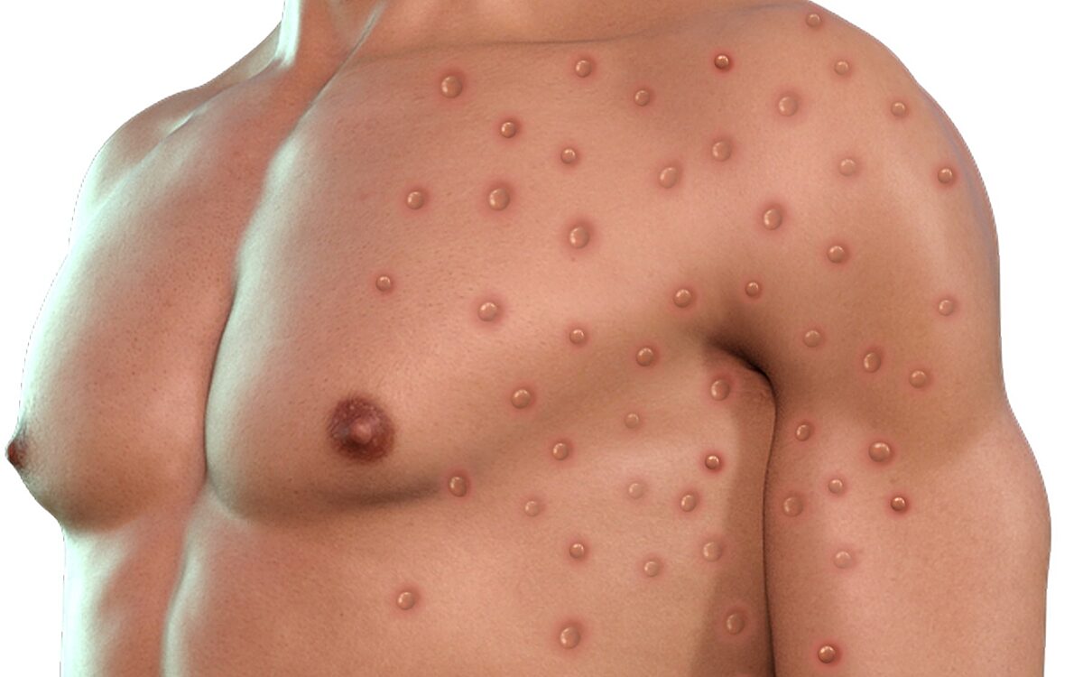 Symbolbild Affenpocken Ausschlag Symbolbild Affenpocken Ausschlag